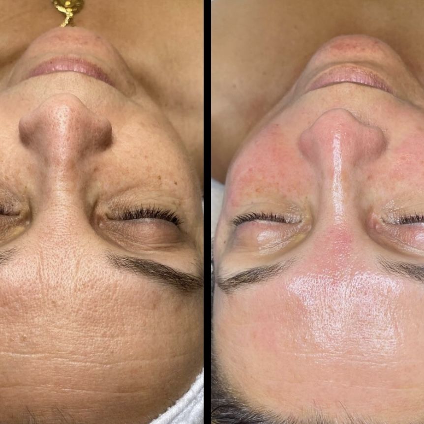 carboxytherapie