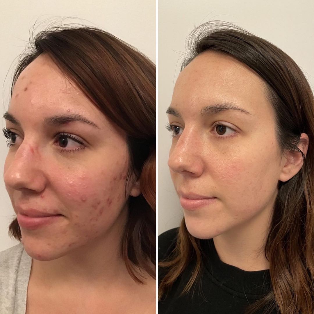 hydrafacial lausanne