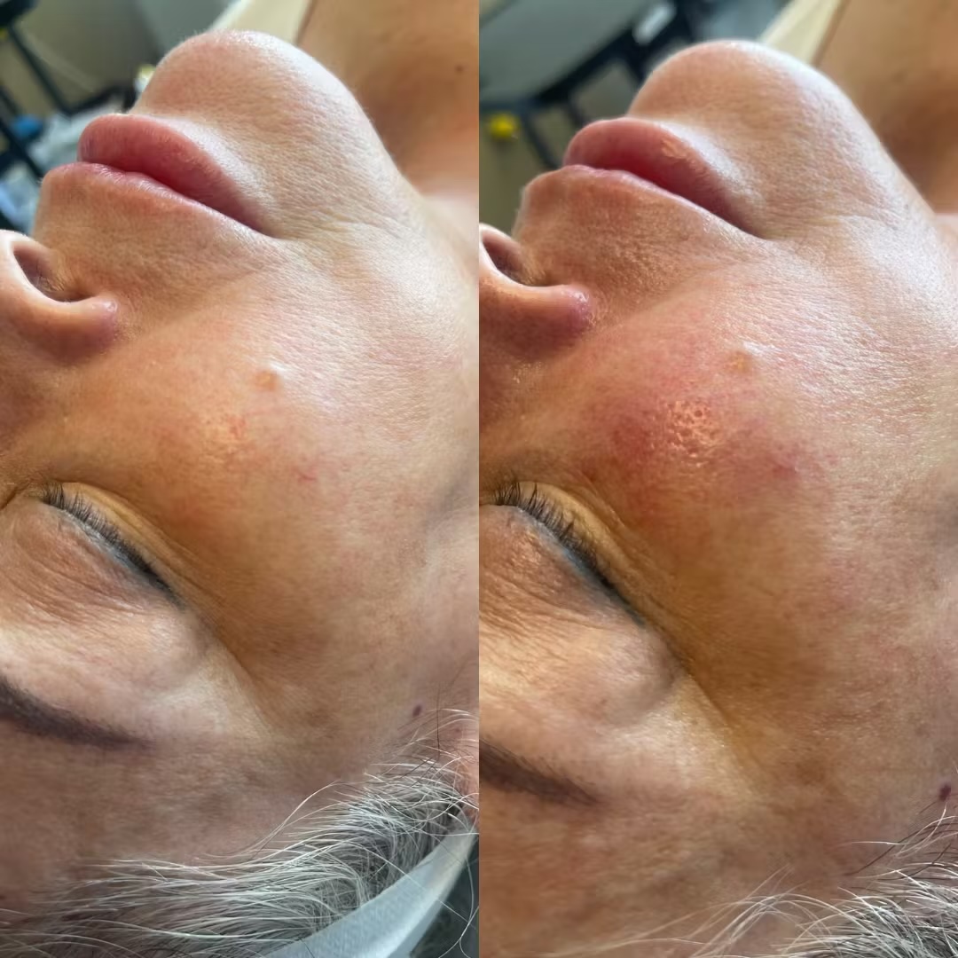 hydrafacial lausanne