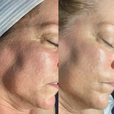 Hydrafacial