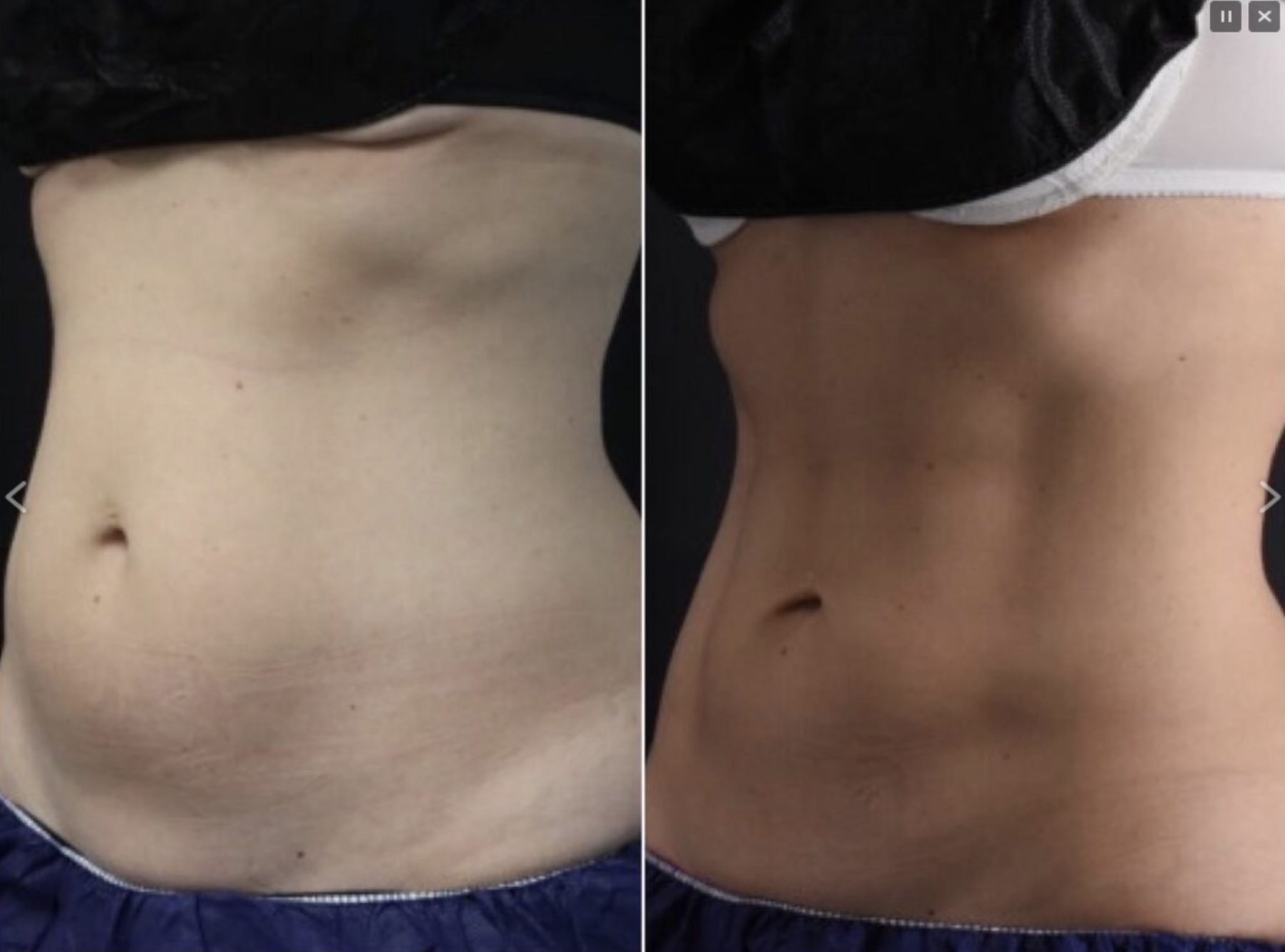 medisculpt