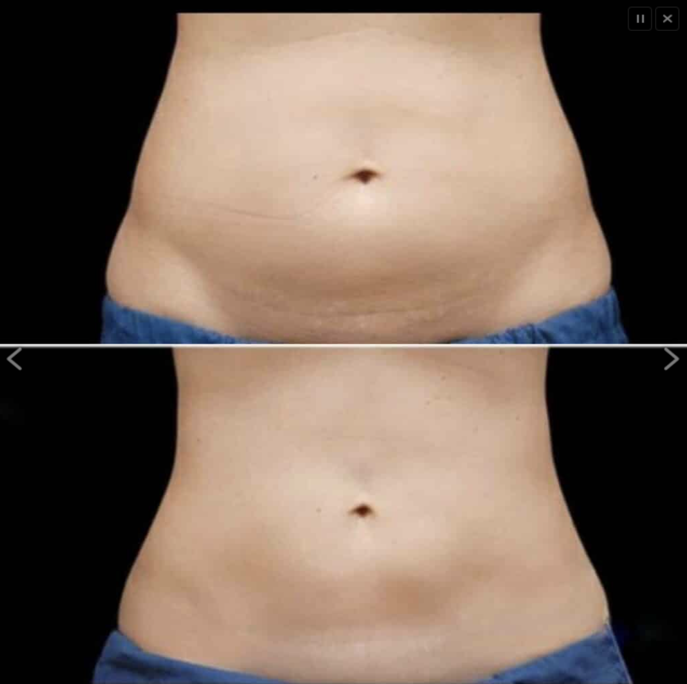 medisculpt