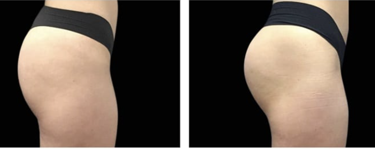 medisculpt