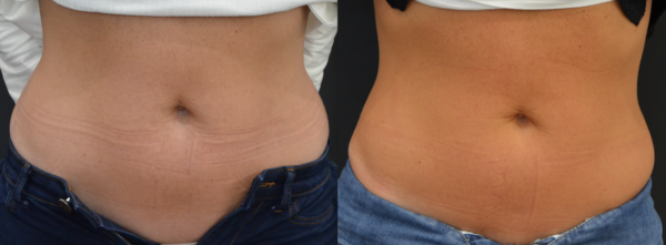 Cryolipolyse résultat
