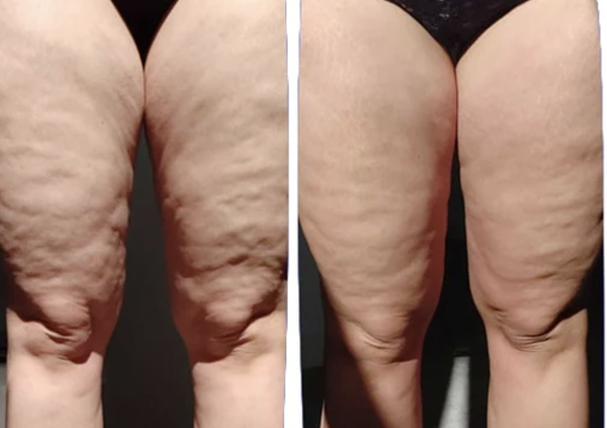 pressotherapie avant après