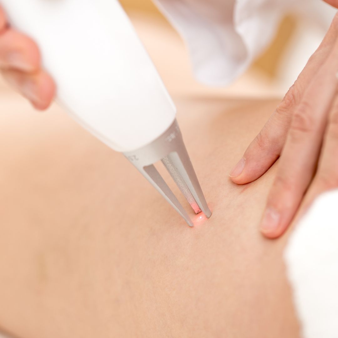 Laser vasculaire 