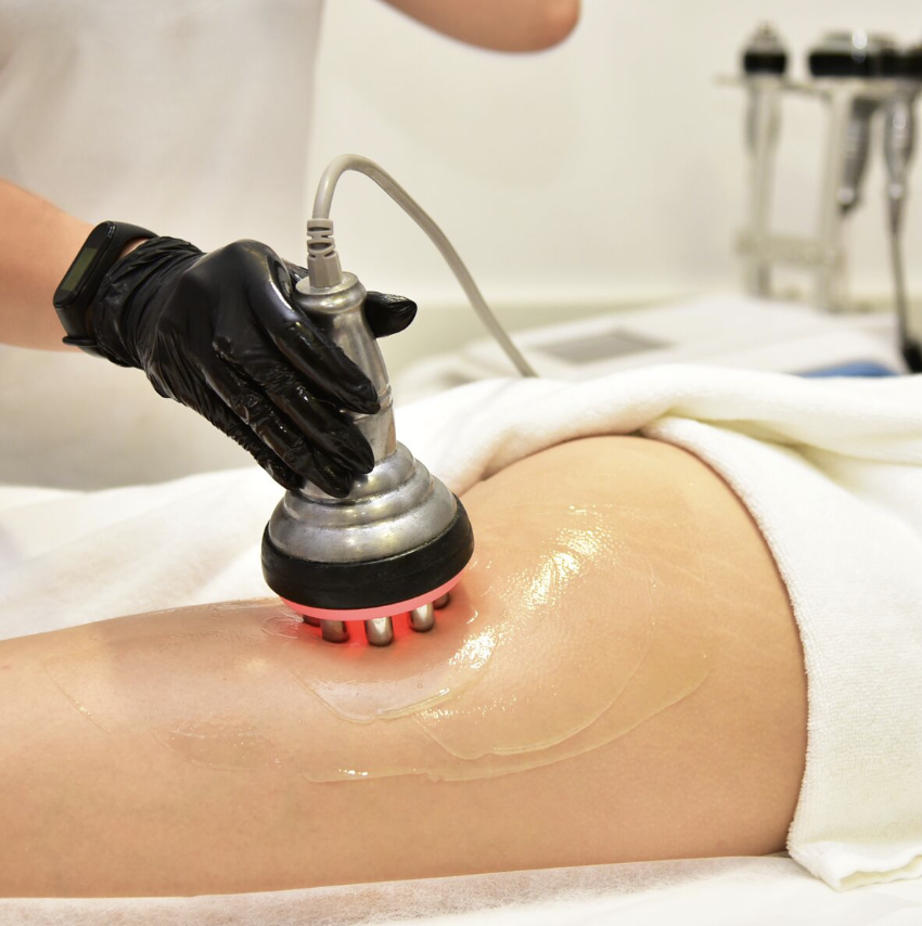 lipocavitation