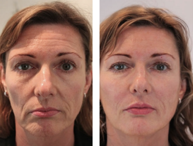 skinbooster avant après
