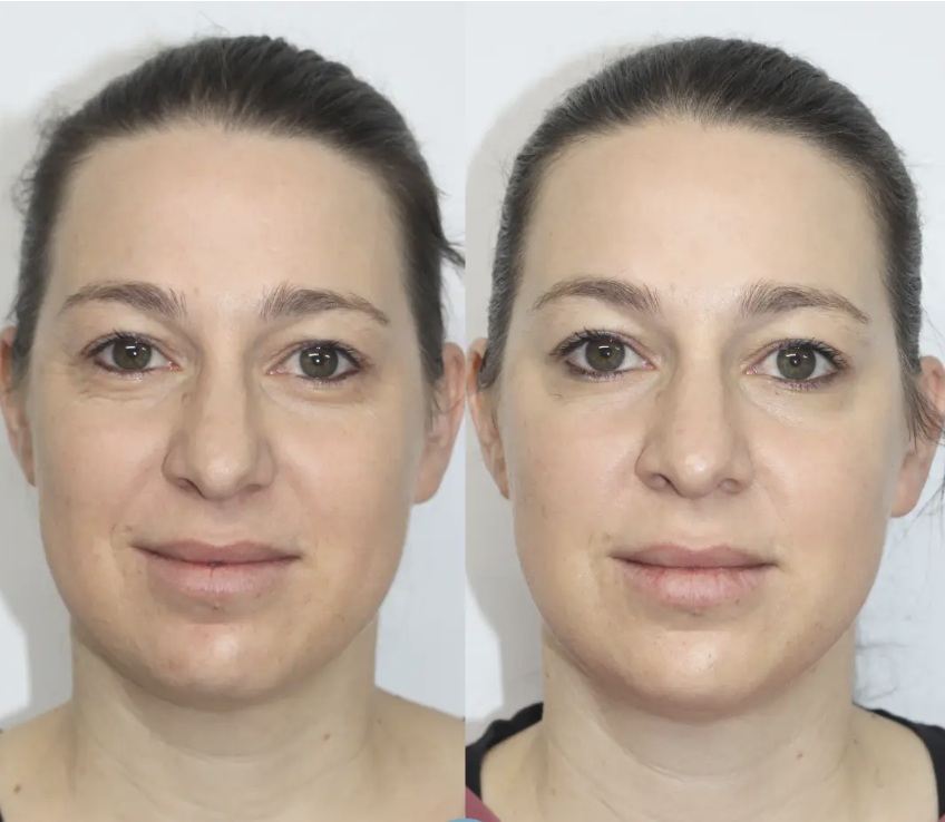 skinbooster avant après