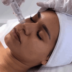 carboxytherapie