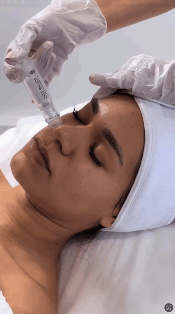 carboxytherapie