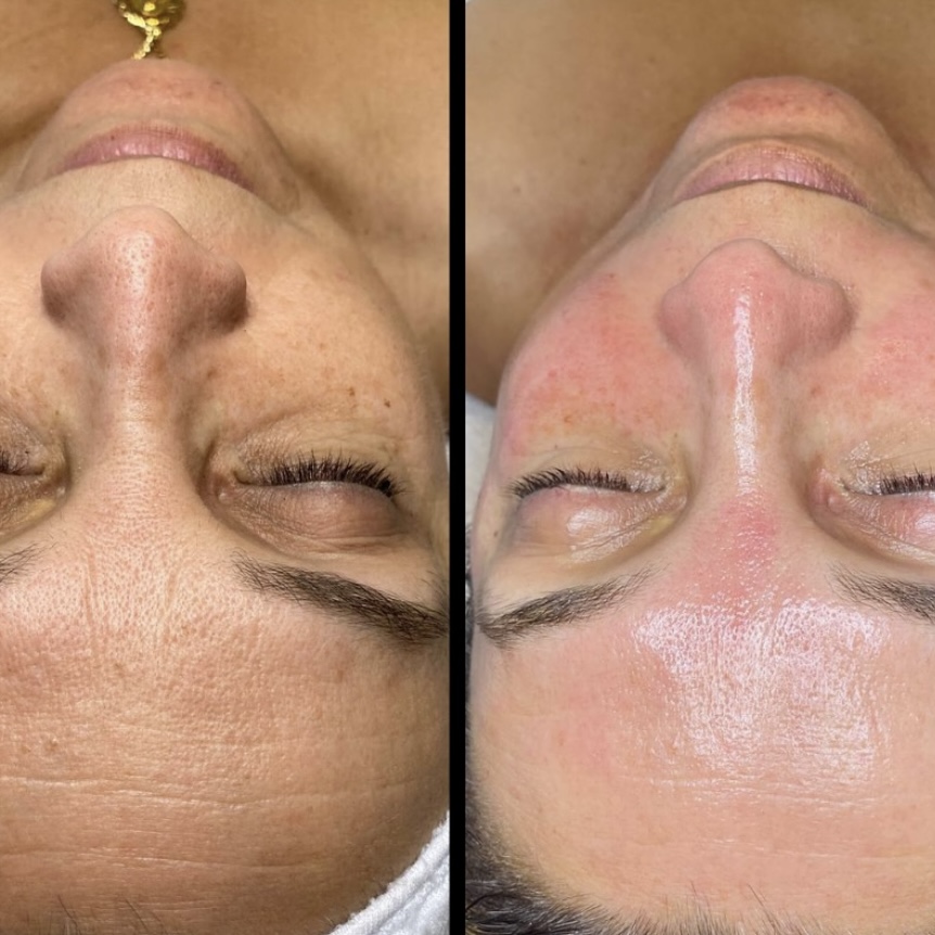 carboxytherapie