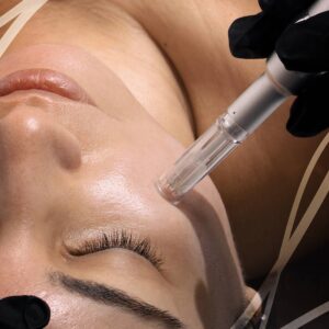 Microneedling (Peeling intégré)