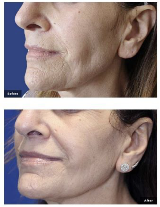 Radiofréquence et Micro-Aiguilles : Soin Secret RF