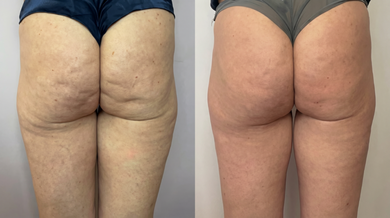 Avant après Endosphères — Maison Evenia Lausanne