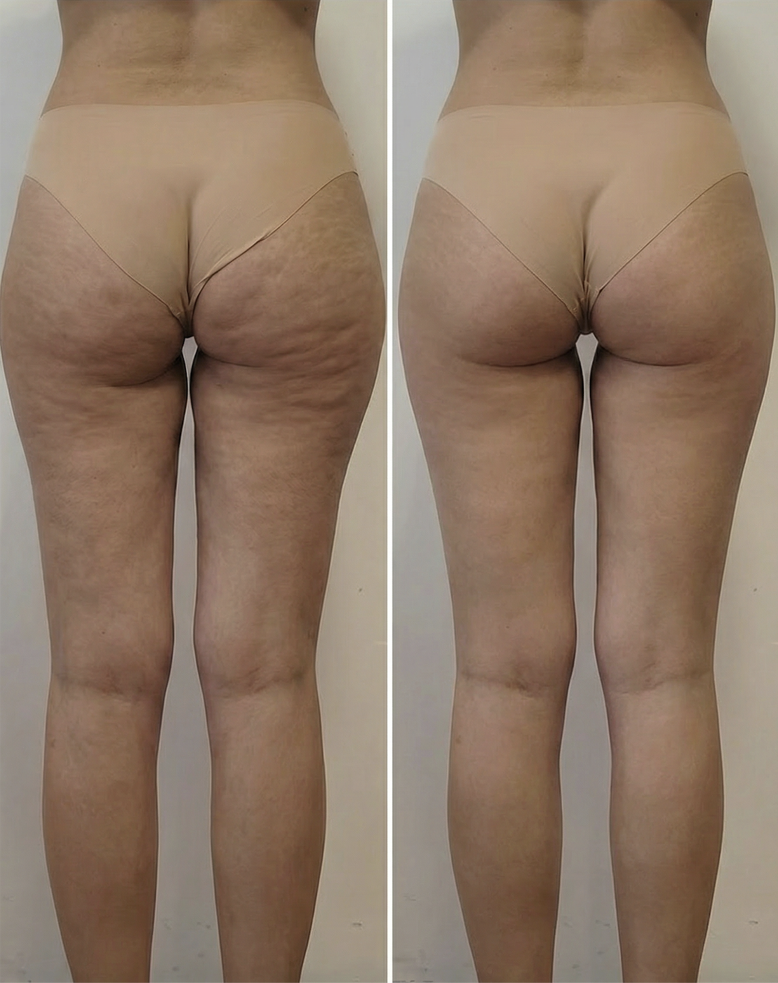 Avant la cure Zéro Complexe — Maison Evenia Lausanne