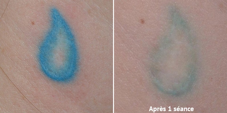Détatouage laser picoseconde, tatouage bleu avant et après 1 séance