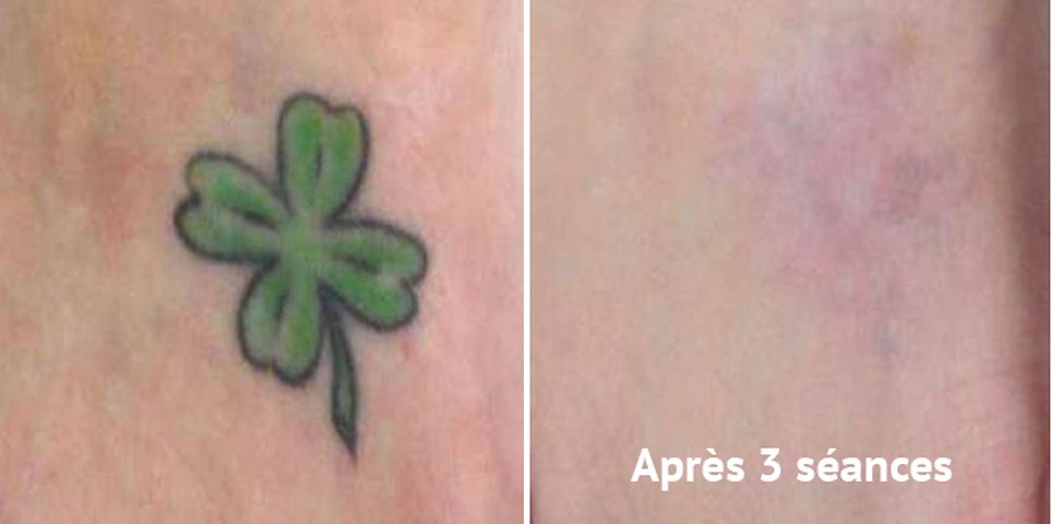 Détatouage laser picoseconde, tatouage trèfle vert avant et après 3 séances