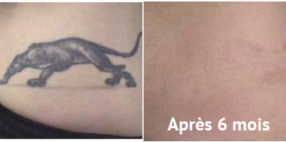Détatouage laser picoseconde, tatouage panthère avant et après 6 mois