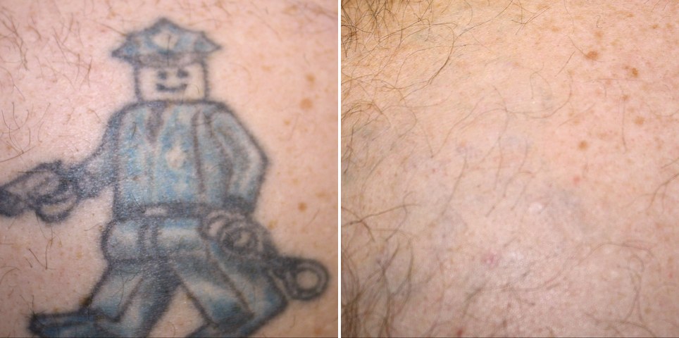 Détatouage laser picoseconde, tatouage personnage bleu et noir avant et après traitement