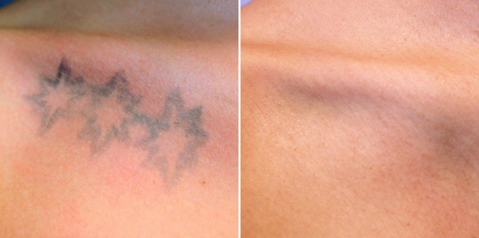 Détatouage laser picoseconde, tatouage étoiles avant et après traitement