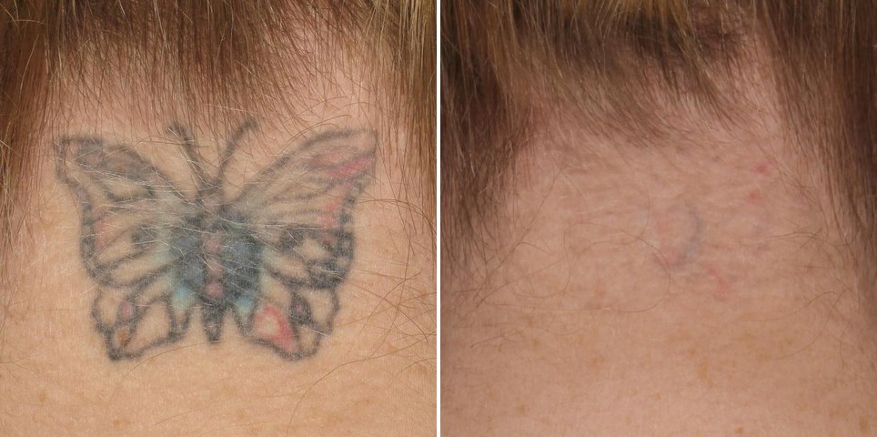 Détatouage laser picoseconde, tatouage papillon sur la nuque avant et après traitement