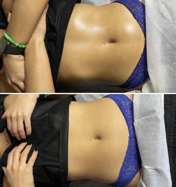 drainage lymphatique