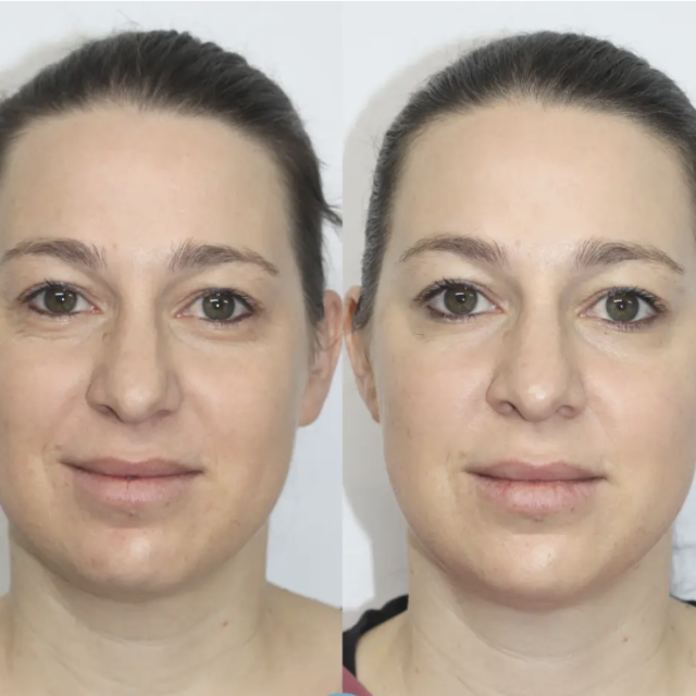 skinbooster avant après