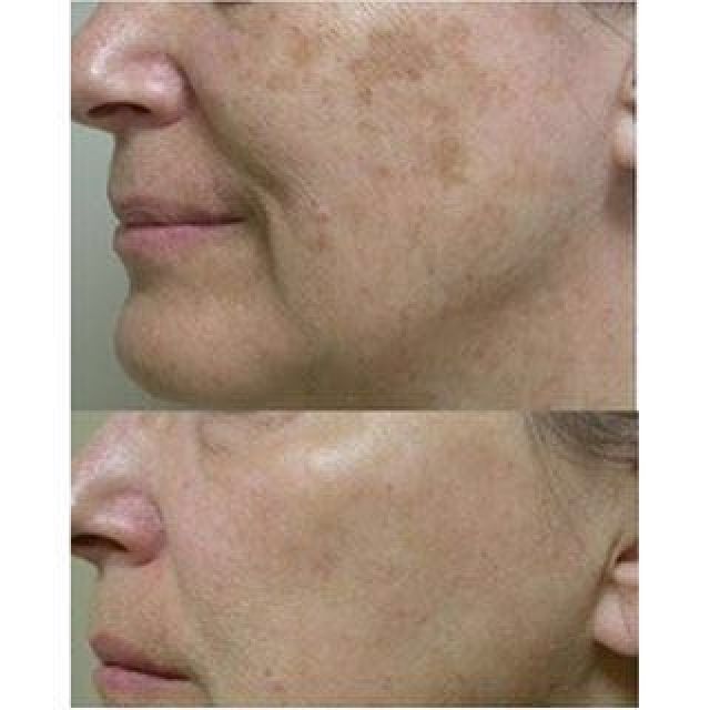 Tesla Med avant après