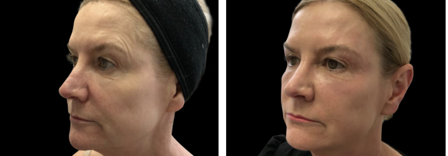 elixis elite résultat