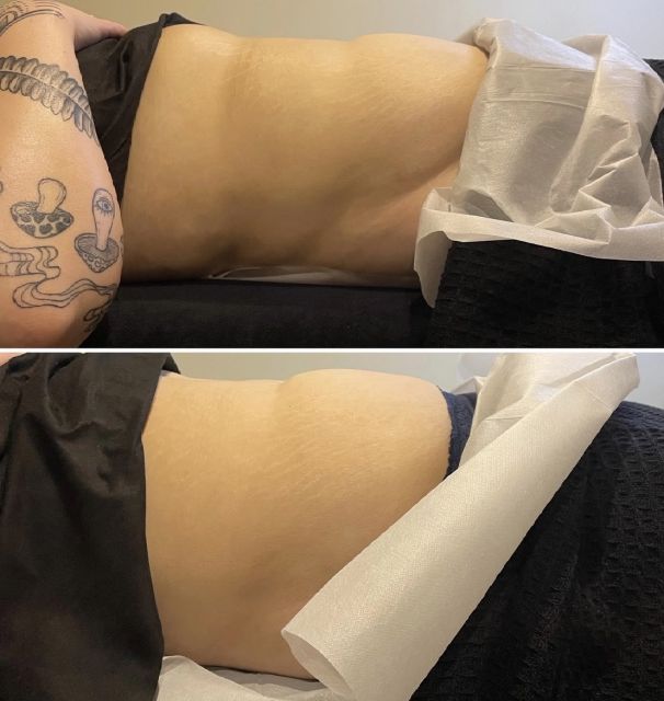 drainage lymphatique