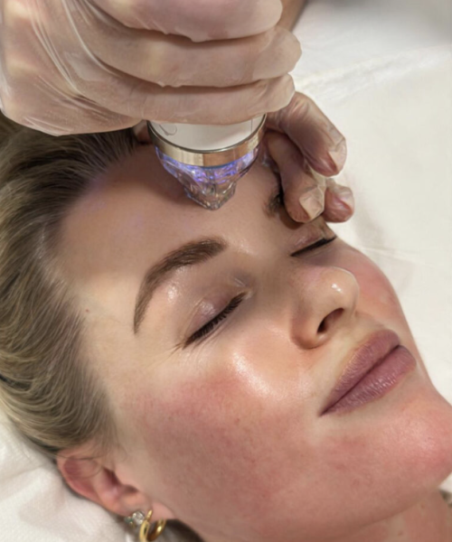 Radiofréquence et Micro-Aiguilles : Soin Secret RF