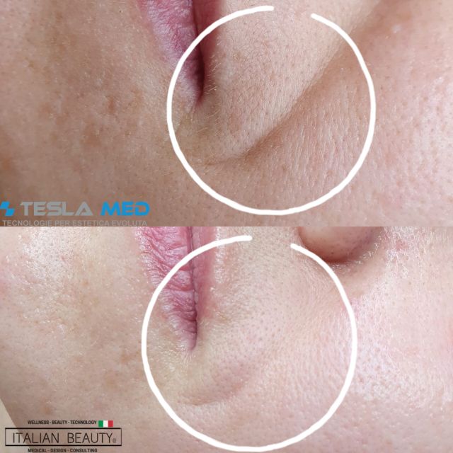 Tesla Med avant apr&egrave;s