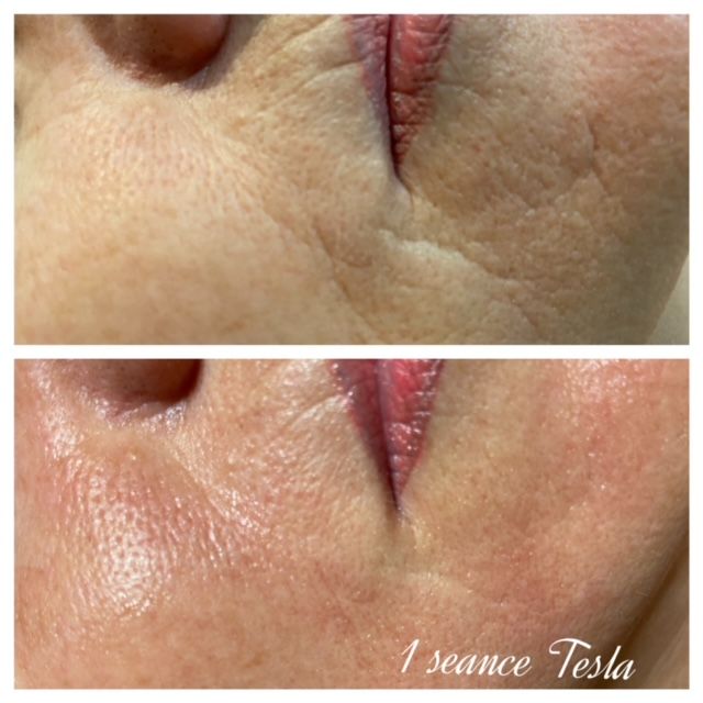 Tesla Med avant après