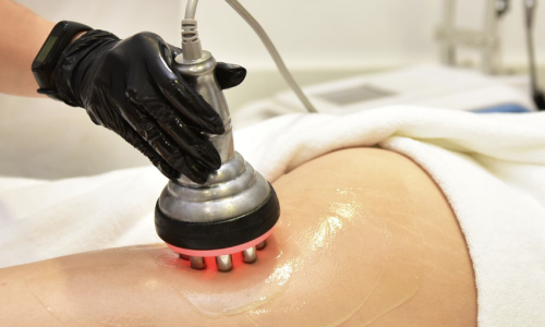 lipocavitation