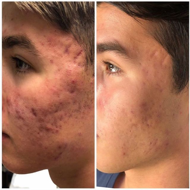 hydrafacial lausanne