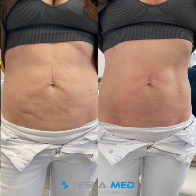 Tesla Med avant après