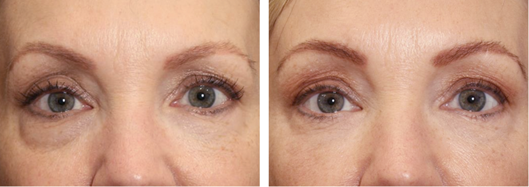 Elixis visage avant après