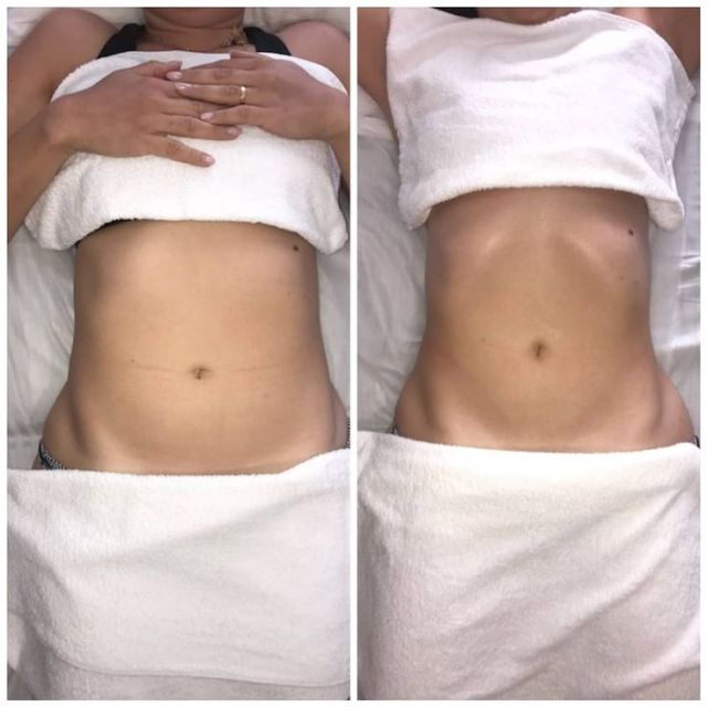 drainage lymphatique