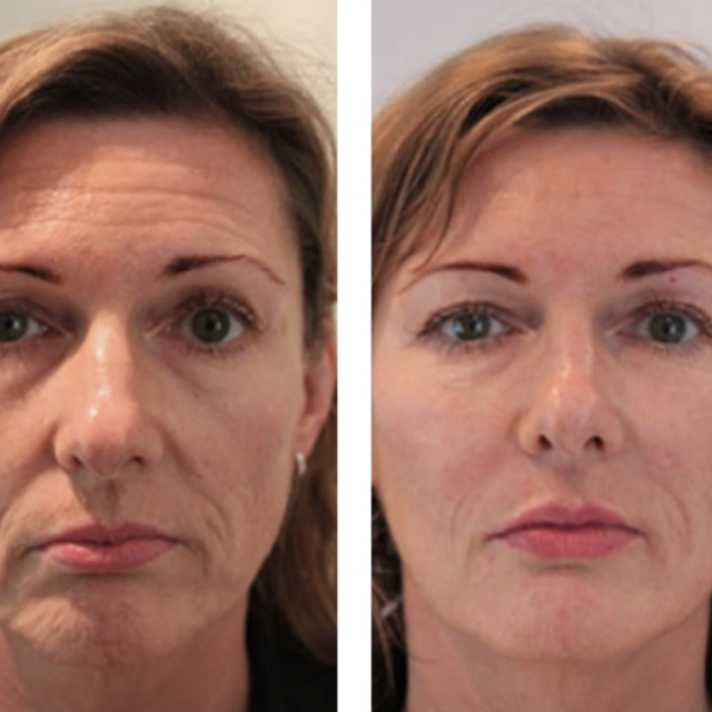 skinbooster avant après