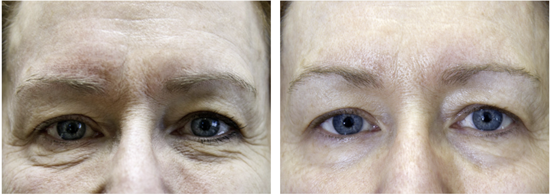 Elixis avant après